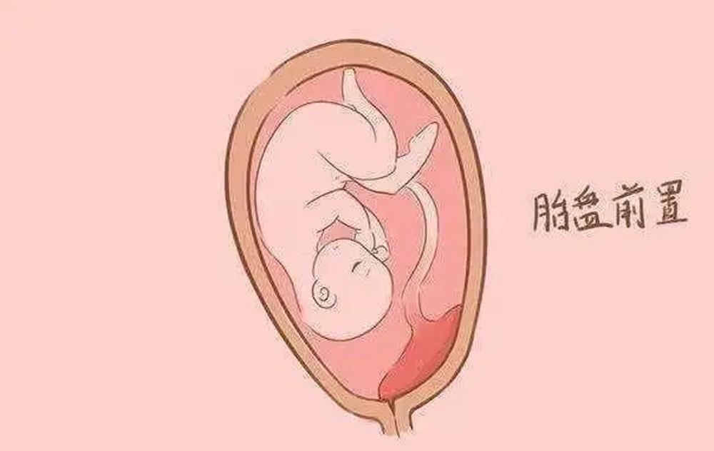 什么是前置胎盘？